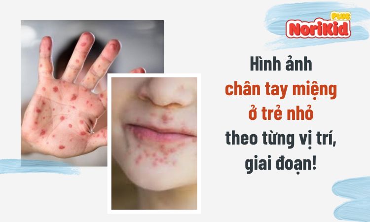 hình ảnh trẻ bị chân tay miệng