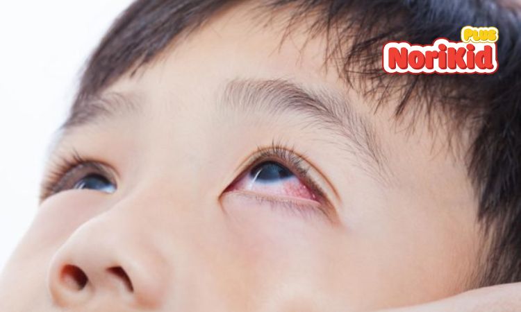 Bệnh đau mắt đỏ ở trẻ có nguy hiểm không? 1