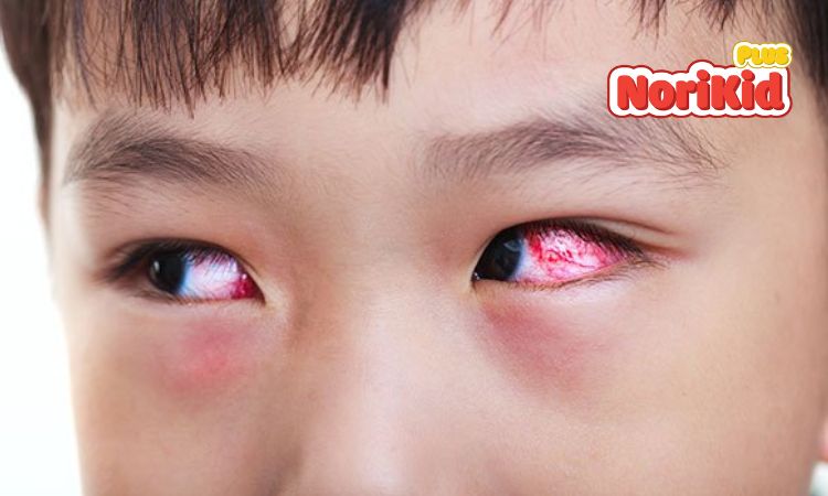 Bệnh đau mắt đỏ ở trẻ em là gì? 1